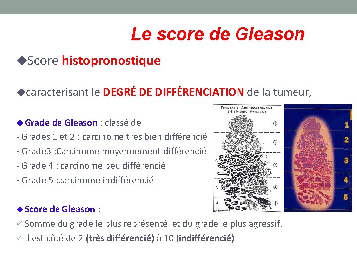 Le score de Gleason Score histopronostique caractérisant le DEGRÉ DE DIFFÉRENCIATION de la tumeur,