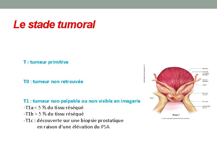 Le stade tumoral T : tumeur primitive T 0 : tumeur non retrouvée T