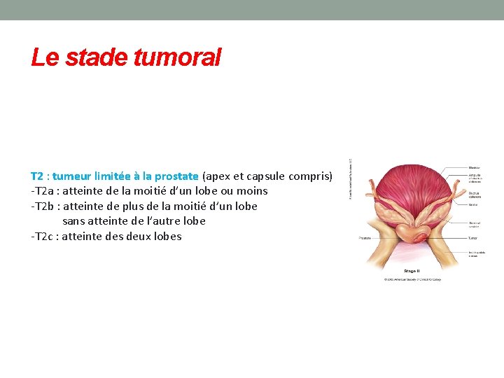 Le stade tumoral T 2 : tumeur limitée à la prostate (apex et capsule