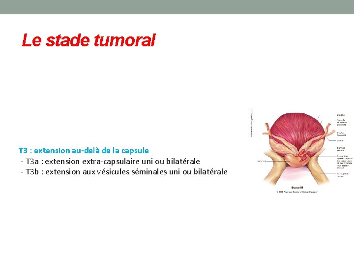 Le stade tumoral T 3 : extension au-delà de la capsule - T 3