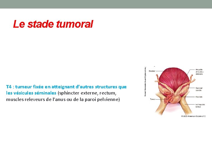 Le stade tumoral T 4 : tumeur fixée en atteignant d’autres structures que les