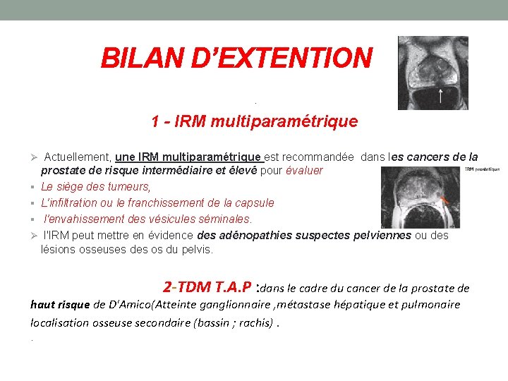 BILAN D’EXTENTION. 1 - IRM multiparamétrique Actuellement, une IRM multiparamétrique est recommandée dans les