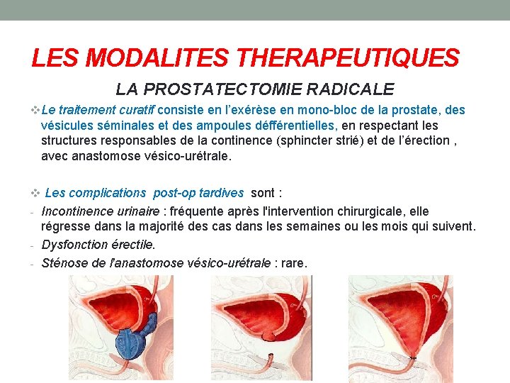 LES MODALITES THERAPEUTIQUES LA PROSTATECTOMIE RADICALE v. Le traitement curatif consiste en l’exérèse en