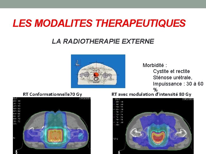 LES MODALITES THERAPEUTIQUES LA RADIOTHERAPIE EXTERNE RT Conformationnelle 70 Gy Morbidité : Cystite et