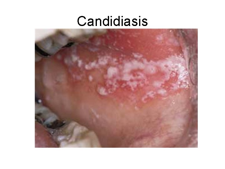 Candidiasis 