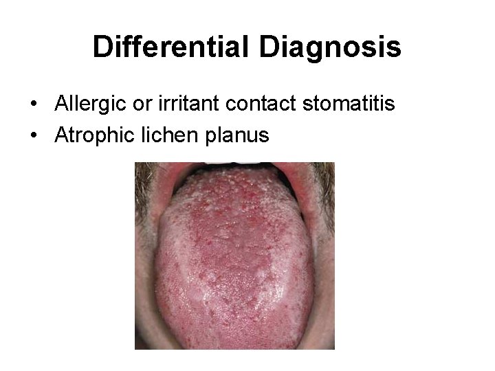 Differential Diagnosis • Allergic or irritant contact stomatitis • Atrophic lichen planus 