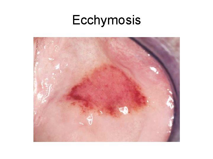 Ecchymosis 