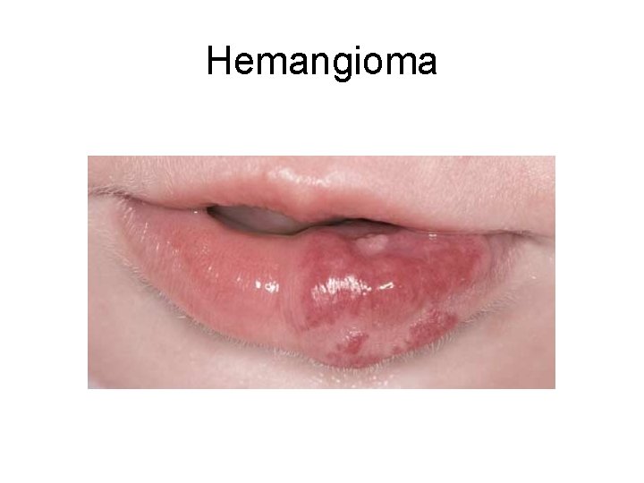Hemangioma 