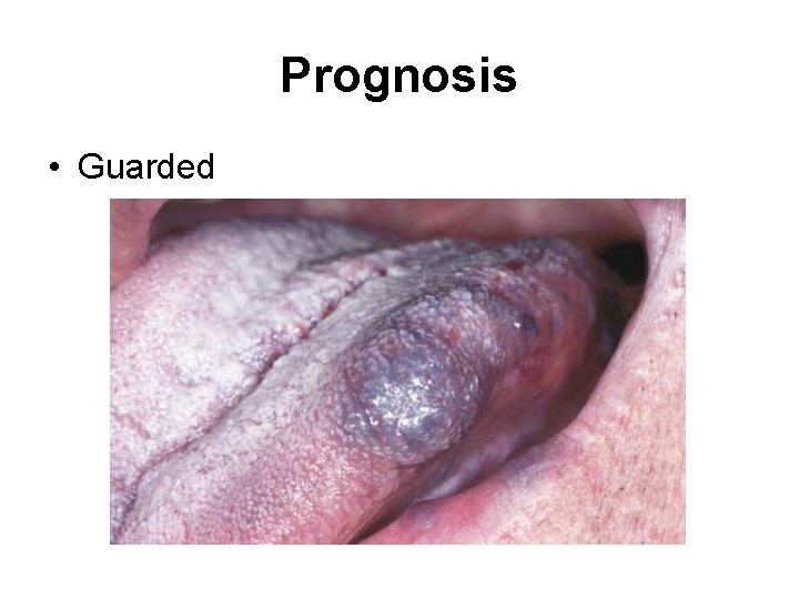 Prognosis • Guarded 