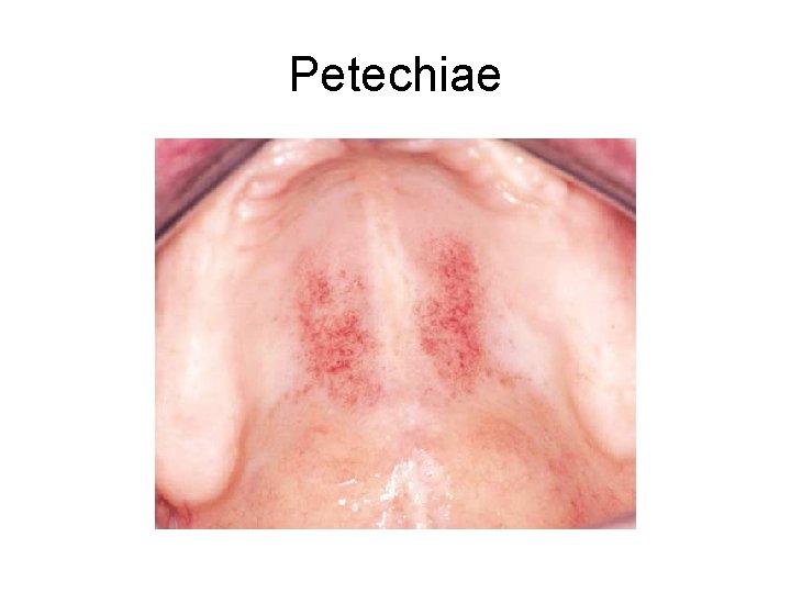 Petechiae 