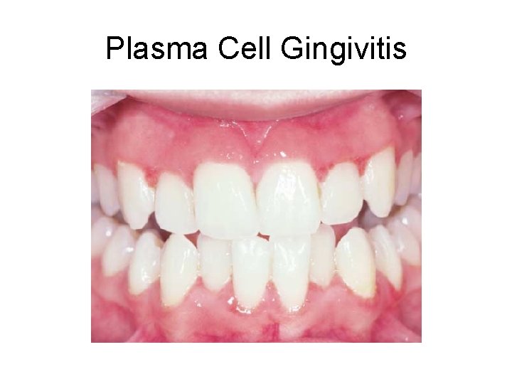 Plasma Cell Gingivitis 