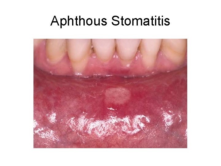 Aphthous Stomatitis 