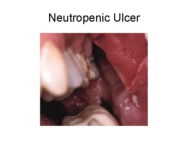 Neutropenic Ulcer 
