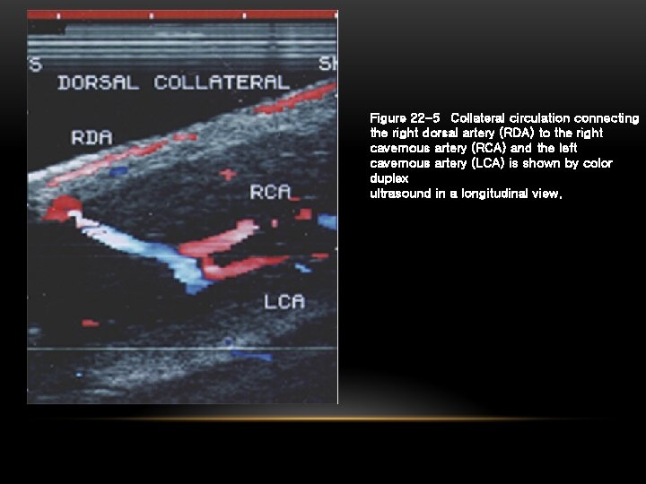 Figure 22 -5 Collateral circulation connecting the right dorsal artery (RDA) to the right