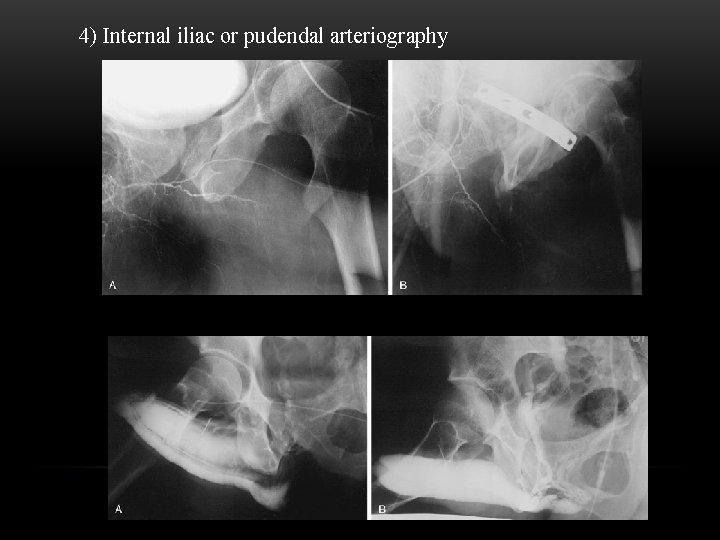 4) Internal iliac or pudendal arteriography 
