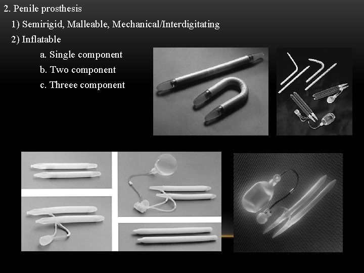 2. Penile prosthesis 1) Semirigid, Malleable, Mechanical/Interdigitating 2) Inflatable a. Single component b. Two