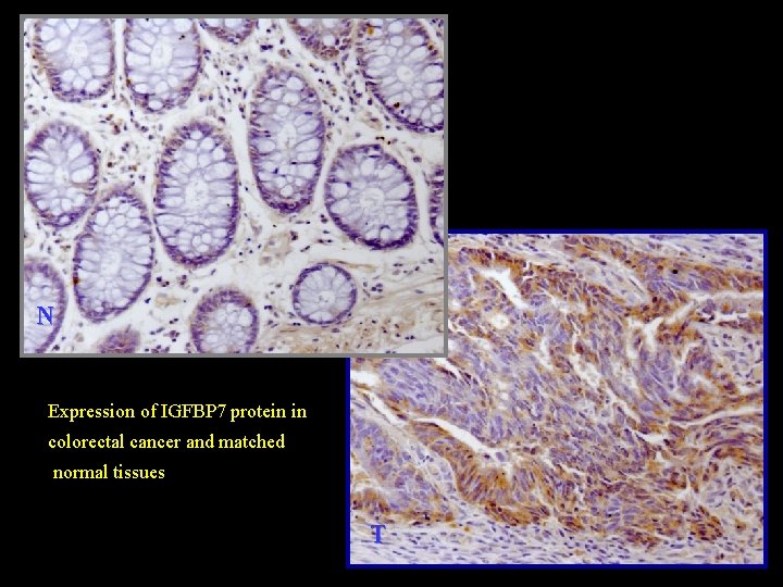 N Expression of IGFBP 7 protein in colorectal cancer and matched normal tissues T