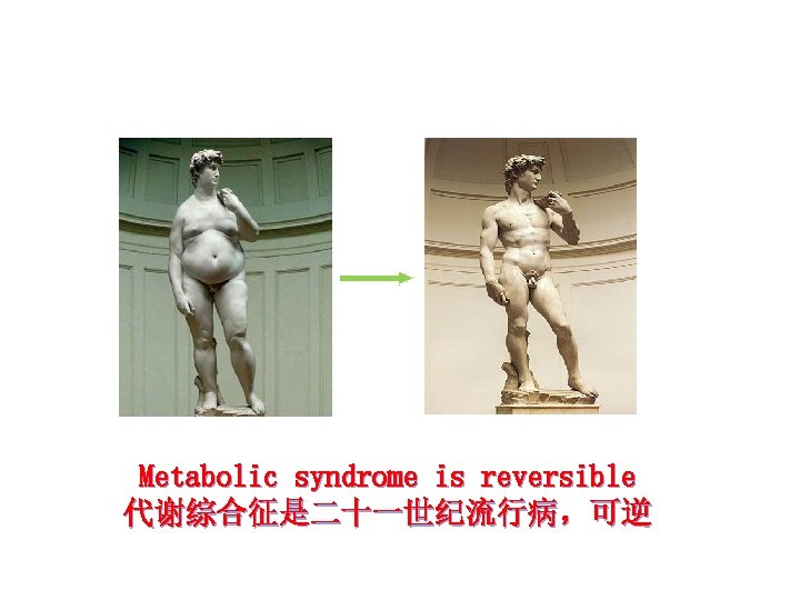 Metabolic syndrome is reversible 代谢综合征是二十一世纪流行病，可逆 