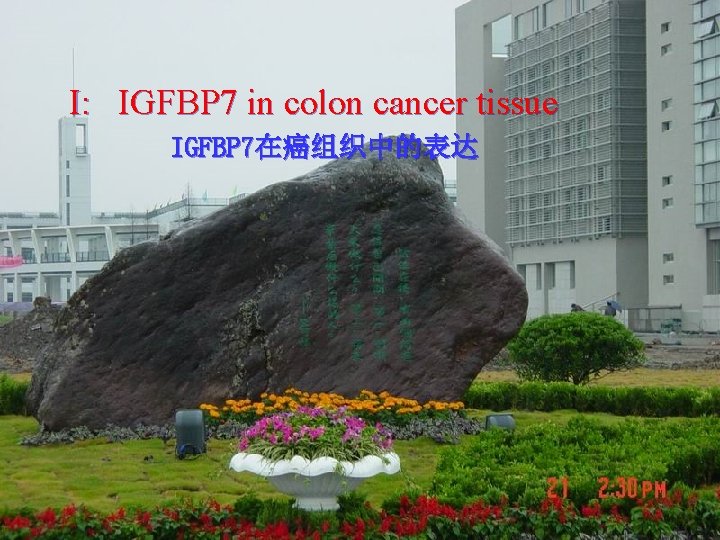 I: IGFBP 7 in colon cancer tissue IGFBP 7在癌组织中的表达 