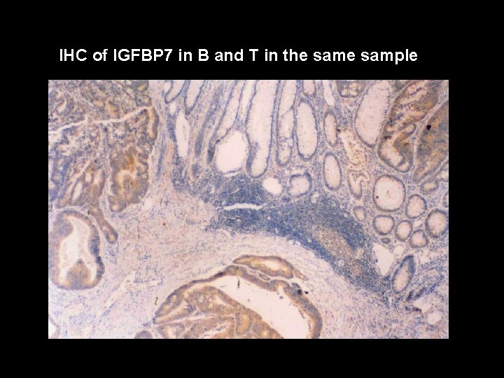 IHC of IGFBP 7 in B and T in the sample 