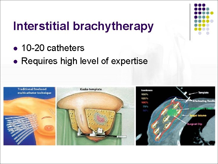 Interstitial brachytherapy l l 10 -20 catheters Requires high level of expertise 
