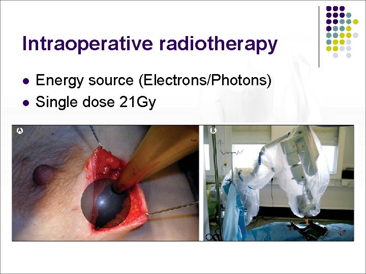 Intraoperative radiotherapy l l Energy source (Electrons/Photons) Single dose 21 Gy 
