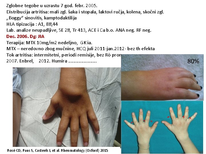 Zglobne tegobe u uzrastu 7 god. febr. 2005. Distribucija artritisa: mali zgl. šaka i