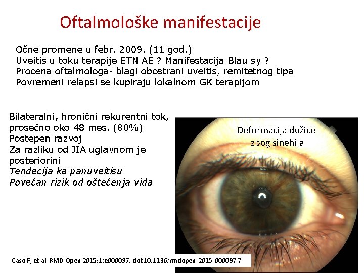 Oftalmološke manifestacije Očne promene u febr. 2009. (11 god. ) Uveitis u toku terapije