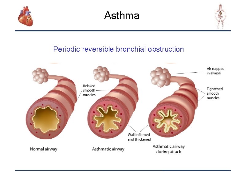 Asthma Periodic reversible bronchial obstruction 15 