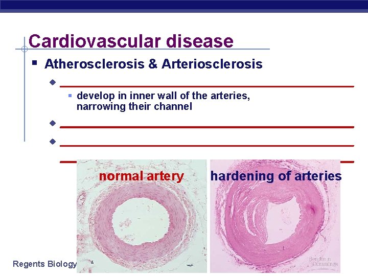 Cardiovascular disease § Atherosclerosis & Arteriosclerosis u ______________________ § develop in inner wall of