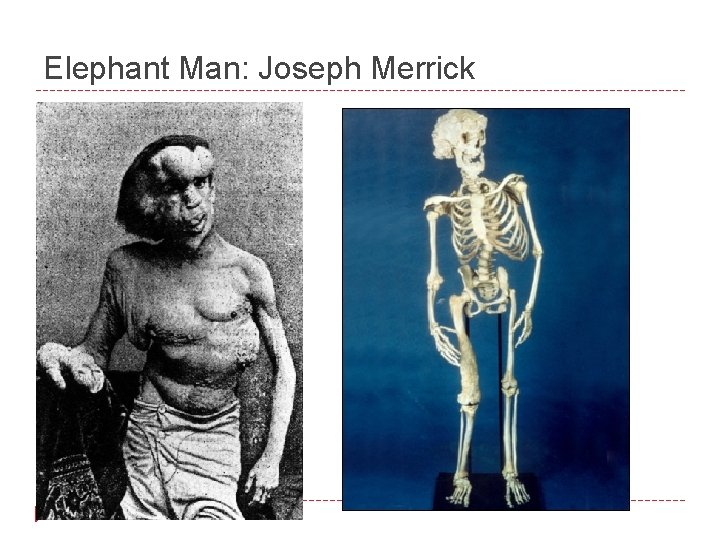 Elephant Man: Joseph Merrick 