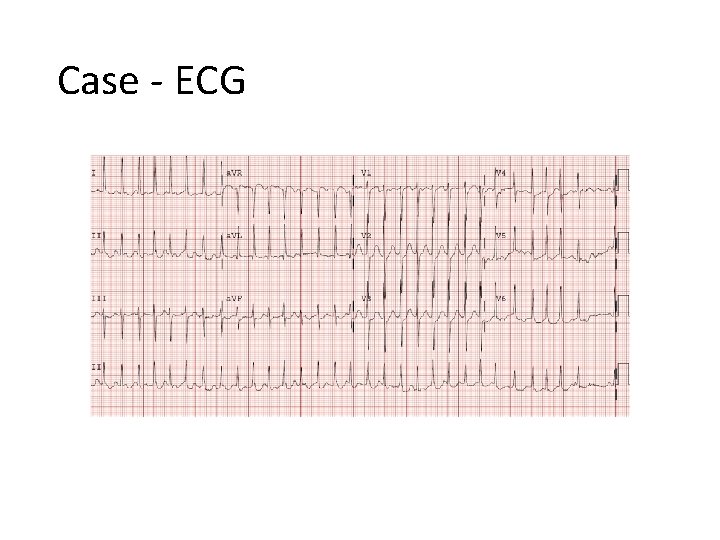 Case - ECG 