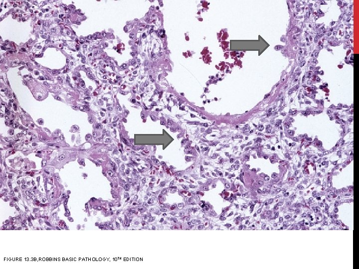 FIGURE 13. 3 B, ROBBINS BASIC PATHOLOGY, 10 TH EDITION 