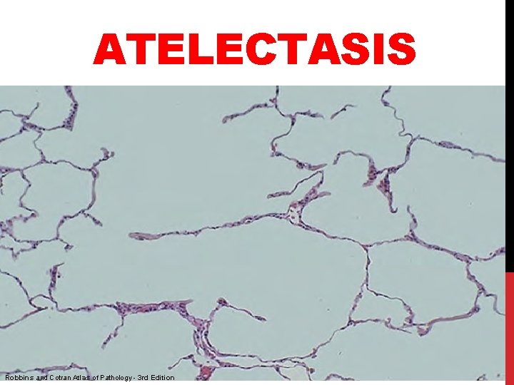 ATELECTASIS Robbins and Cotran Atlas of Pathology - 3 rd Edition 