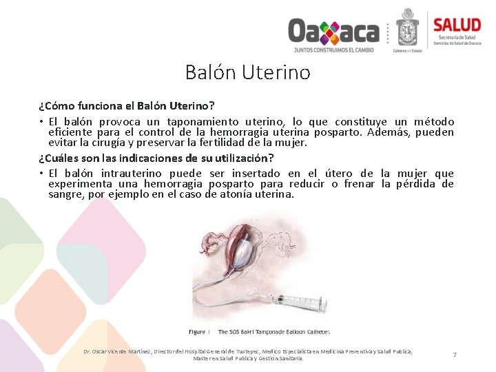 Balón Uterino ¿Cómo funciona el Balón Uterino? • El balón provoca un taponamiento uterino,