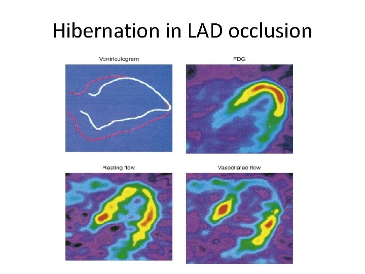 Hibernation in LAD occlusion 