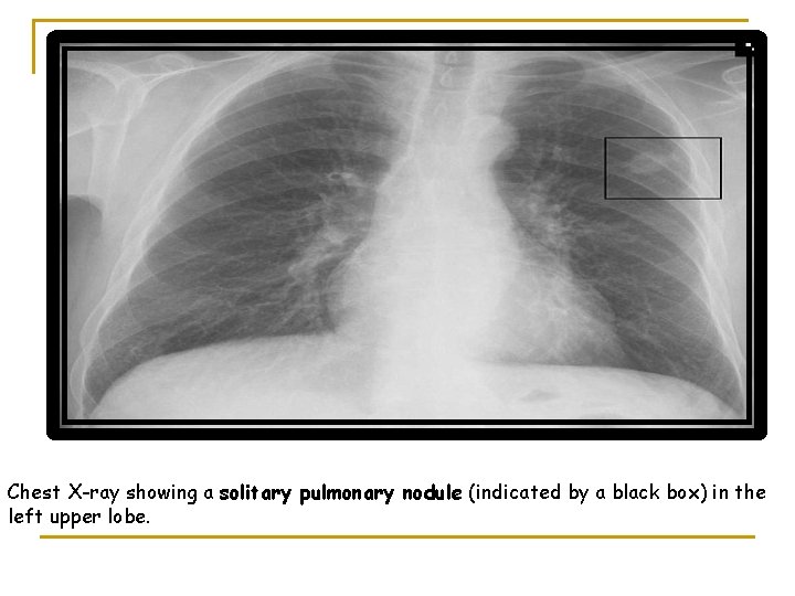 Chest X-ray showing a solitary pulmonary nodule (indicated by a black box) in the