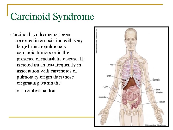 Carcinoid Syndrome Carcinoid syndrome has been reported in association with very large bronchopulmonary carcinoid