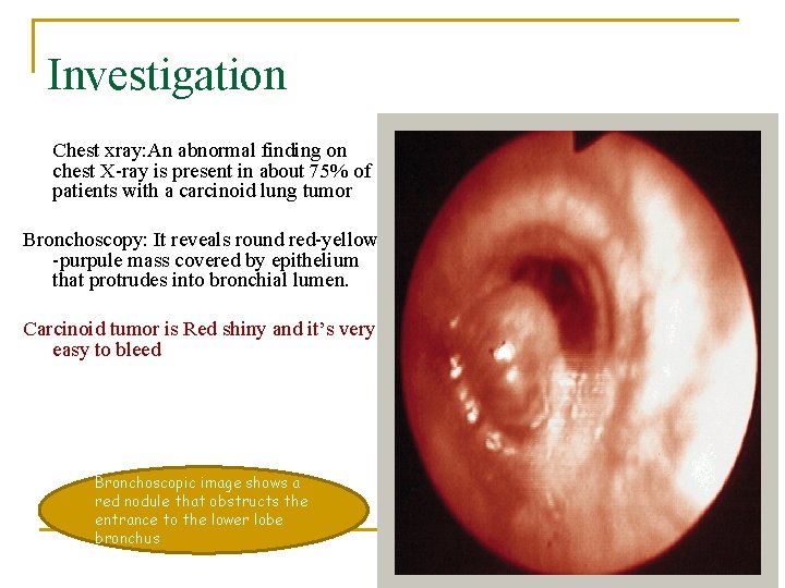 Investigation Chest xray: An abnormal finding on chest X-ray is present in about 75%
