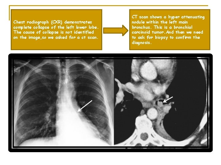 Chest radiograph (CXR) demonstrates complete collapse of the left lower lobe. The cause of