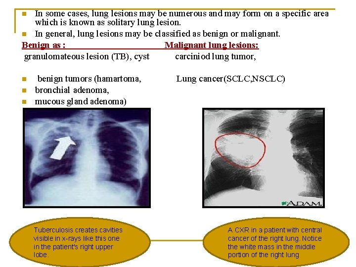 In some cases, lung lesions may be numerous and may form on a specific