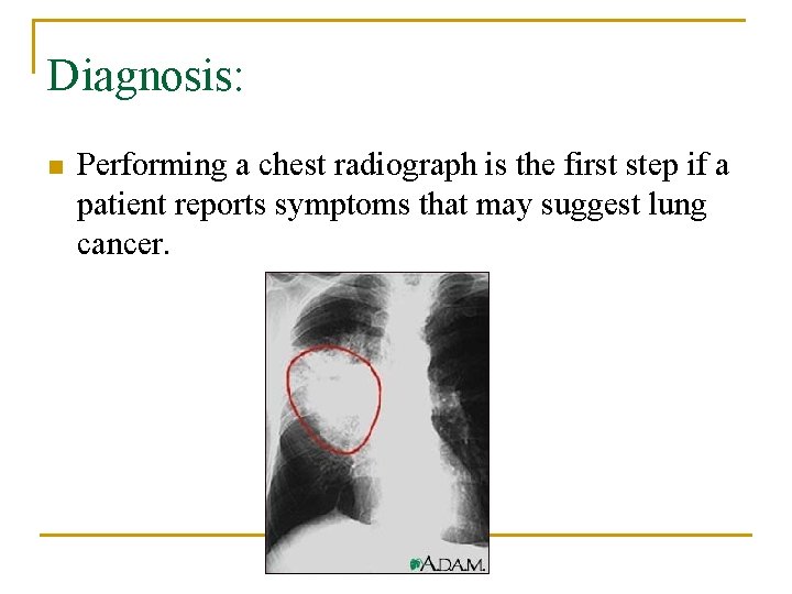 Diagnosis: n Performing a chest radiograph is the first step if a patient reports
