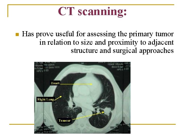 CT scanning: n Has prove useful for assessing the primary tumor in relation to