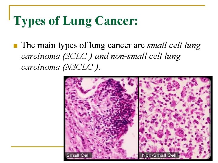 Types of Lung Cancer: n The main types of lung cancer are small cell