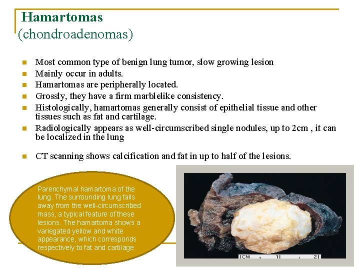 Hamartomas (chondroadenomas) n n n n Most common type of benign lung tumor, slow
