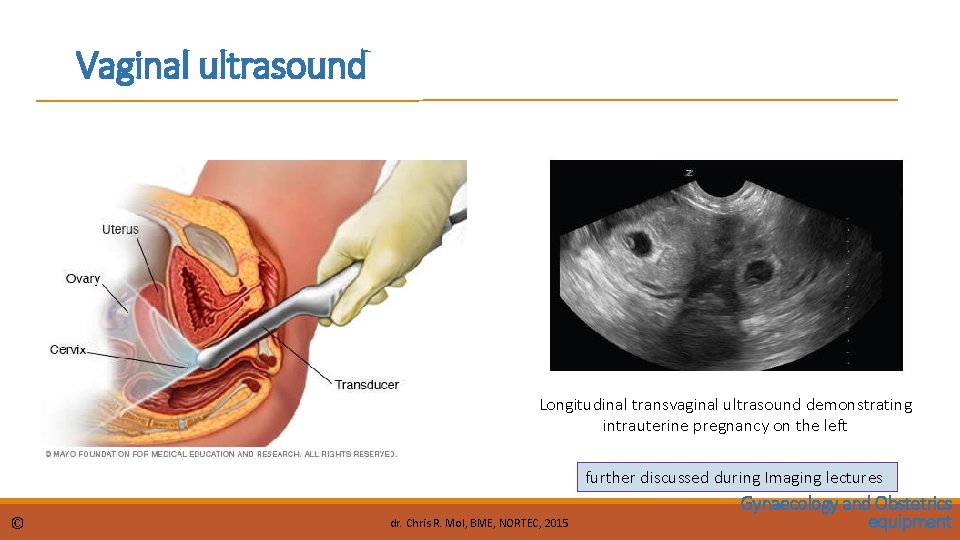 Vaginal ultrasound Longitudinal transvaginal ultrasound demonstrating intrauterine pregnancy on the left further discussed during