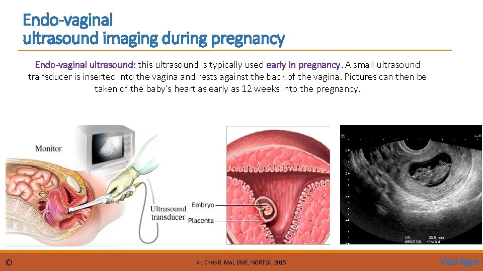 Endo-vaginal ultrasound imaging during pregnancy Endo-vaginal ultrasound: this ultrasound is typically used early in