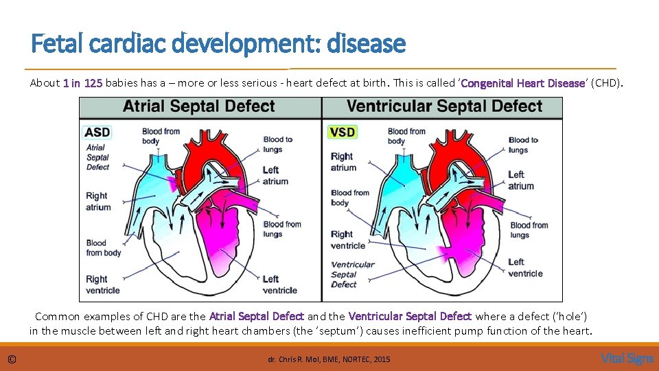 Fetal cardiac development: disease About 1 in 125 babies has a – more or