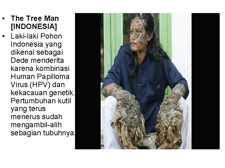  • The Tree Man [INDONESIA] • Laki-laki Pohon Indonesia yang dikenal sebagai Dede
