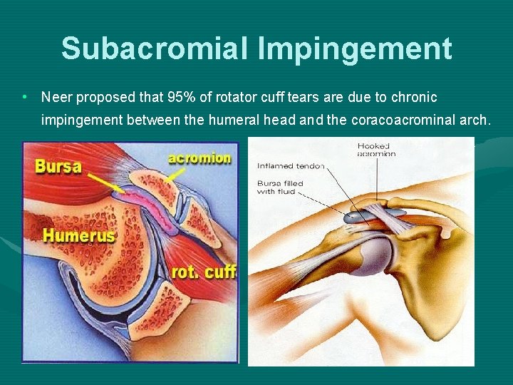 Subacromial Impingement • Neer proposed that 95% of rotator cuff tears are due to